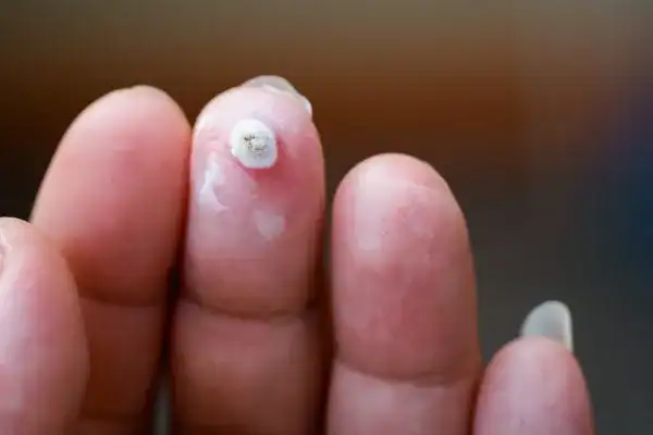 Image of white wart before cryopen treatment Pinner
