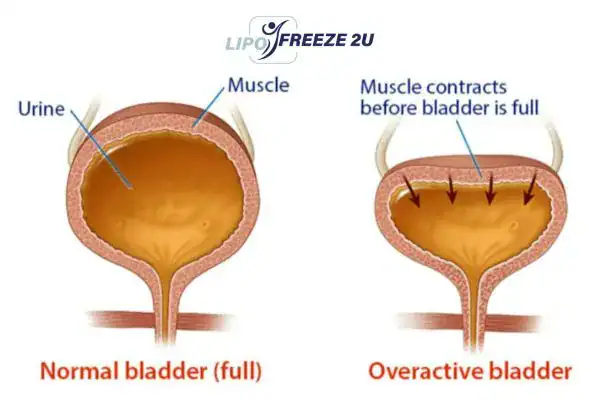 diagram of overactive bladder treatment Pinner