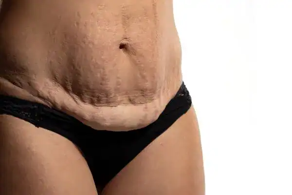 loose skin after weight loss injections Pinner