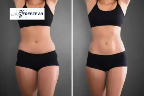 How Can LIPO FREEZE 2U Support Your Post-Pregnancy Body Recovery Pinner?