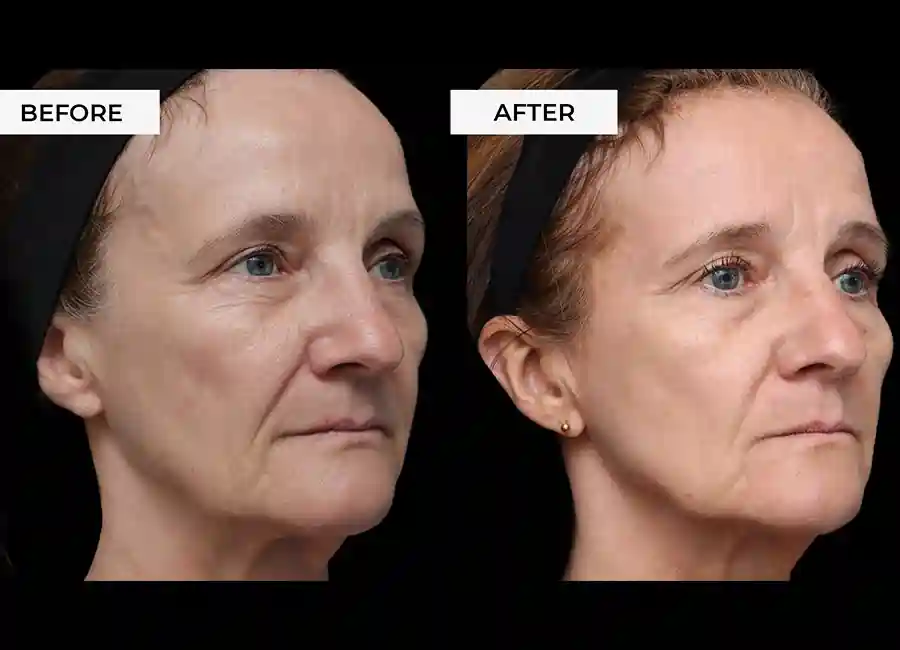How Many RF Microneedling Sessions Will You Need to See a Difference Pinner?