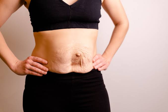 Is Surgery Really the Only Way to Repair Diastasis Recti Pinner?
