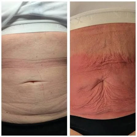 How Does RF Microneedling Improve Crepey, Thin and Uneven Skin Texture Pinner?