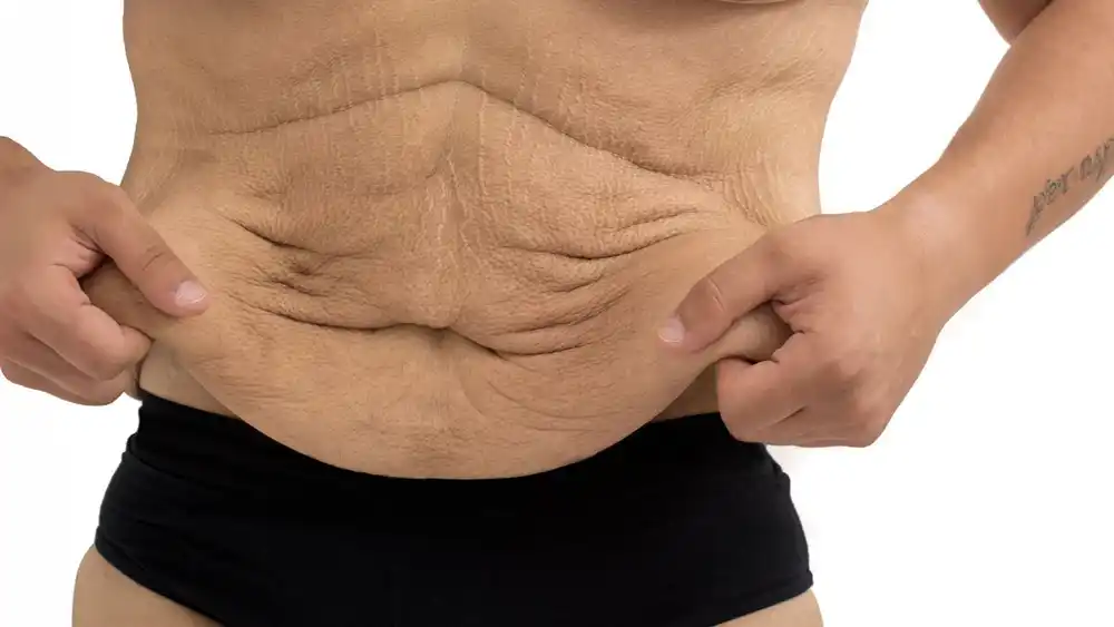 RF Microneedling for Loose Skin: How Can It Help Tighten and Reshape the Skin Pinner?